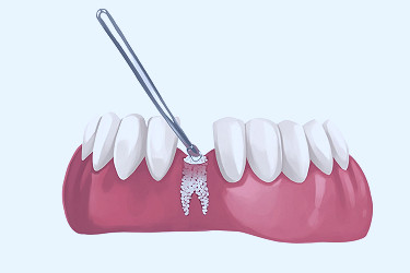 What Are Dental Bone Grafts and Do I Need Them?